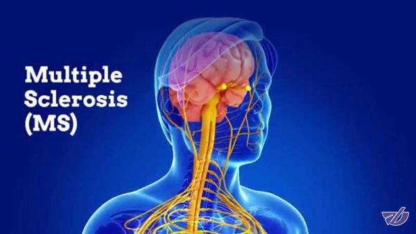 یک توصیه سودمند برای مبتلایان به ام اس